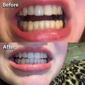 DR Dent Purple Whitening Strips