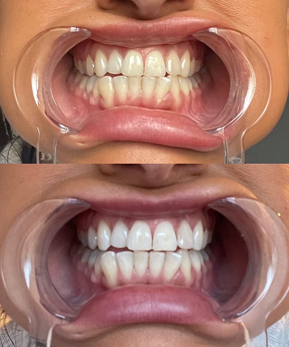 DR Dent Purple Whitening Strips