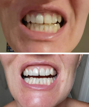 DR Dent Purple Whitening Strips